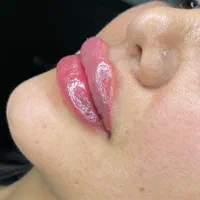 تخفیف ویژه فیلرلب،ژل،انزیم لب،بوتاکس،پی ار پی|خدمات آرایشگری و زیبایی|بندرعباس, |دیوار