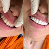 ( ایمپلنت بدون جراحی پانچ از ۶ تومن )|خدمات آرایشگری و زیبایی|اصفهان, سرچشمه|دیوار