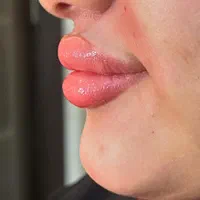 خدمات فیلر زیبایی ،فیشیال تخصصی ،هایفوتراپی|خدمات آرایشگری و زیبایی|زاهدان, |دیوار