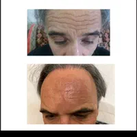 بوتاکس پیشانی تعریق زیر بغل کف دست