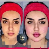 تزریق ژل و بوتاکس و مادلینگ خلیجی و هایفو درکلینیک|خدمات آرایشگری و زیبایی|کرمانشاه, |دیوار