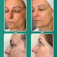 لیزر مو حتی کرکی ، لیزر انواع تتو ،لیزر سفیدکننده|خدمات آرایشگری و زیبایی|ایلام, |دیوار