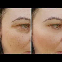 تخصصی پی آر پیprp مزو بوتاکس فیلر ژل حجامت فصد|خدمات آرایشگری و زیبایی|اصفهان, جلفا|دیوار
