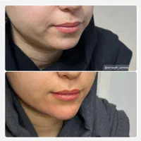 تزریق ژل و بوتاکس و فیشال تخصصی توسط پزشک|خدمات آرایشگری و زیبایی|برازجان, |دیوار
