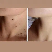 حذف کک و مک ،خال ،منگوله گوشتی بدون برگشت گیاهی|آرایشی، بهداشتی، درمانی|زنجان, |دیوار