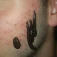 چکاب.حجامت.زالو.سم زدایی.جاانداختن رگ|خدمات آرایشگری و زیبایی|بم, |دیوار