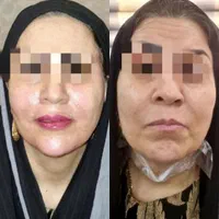پوست صاف ویکدست میخوای متن آگهی روبخون+پیشنهادویژه|خدمات آرایشگری و زیبایی|قم, باجک دو|دیوار