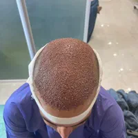 کاشت با ۶ تومان پیش پرداخت|خدمات آرایشگری و زیبایی|مشهد, ملک‌آباد|دیوار