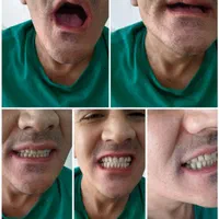 دندانسازی مصنوعی حرفه ای برای همه لبخندها|خدمات آرایشگری و زیبایی|مشهد, کوی سیدی|دیوار
