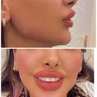 ژل بوتاکس فیلر مزوتراپی پیرسینگ و آموزش حرفه ایی|خدمات آرایشگری و زیبایی|قم, هنرستان|دیوار