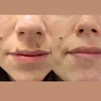 حذف کک و مک ،خال ،منگوله گوشتی بدون برگشت گیاهی|آرایشی، بهداشتی، درمانی|زنجان, |دیوار