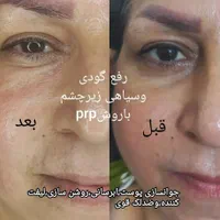 تخفیف ویژه فیلرلب،ژل،انزیم لب،بوتاکس،پی ار پی|خدمات آرایشگری و زیبایی|بندرعباس, |دیوار