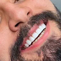 مدل کامپوزیت دندان|خدمات آرایشگری و زیبایی|تهران, هاشمی|دیوار