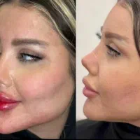 تخفیف ژل بوتاکس مزودرکلینیک