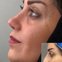 جراحی زیبائی بینی عمل بینی لیفت شقیقه پلک گوش غبغب|خدمات آرایشگری و زیبایی|اصفهان, مرداویج|دیوار