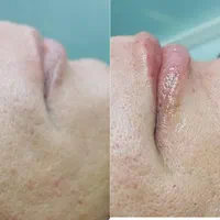 جشنواره بوتاکس، پی آر پی کاشت نخ، فیلر  ، فیشال
