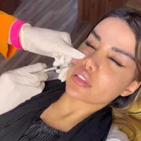 دکتر متخصص تزریق ژل لب روسی فیلر بینی زاویه پزشک|خدمات آرایشگری و زیبایی|تهران, پونک|دیوار