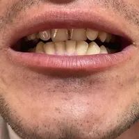 آفرعیدانه‌‌‌طرح‌لبخندکامپوزیت‌ولمینت‌دندان|خدمات آرایشگری و زیبایی|تهران, شهید رجایی|دیوار
