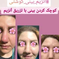 آنزیم ژل لب.بینی.غعبغب. ژل های گلوله شده چربی سوز|خدمات آرایشگری و زیبایی|خرم‌آباد, |دیوار