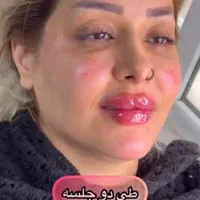 تزریق ژل و بوتاکس (اف ویژه ب مناسبت عید مبعث )|خدمات آرایشگری و زیبایی|مشهد, وکیل‌آباد|دیوار