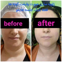 هایفوتراپی،لیفت وجوانسازی صورت،رفع غبغب|خدمات آرایشگری و زیبایی|تهران, ظفر|دیوار