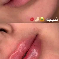 جشنواره تزریق ژل و بوتاکس،فیلرلب،مزو،هایفو،آنزیم|خدمات آرایشگری و زیبایی|کرج, عظیمیه|دیوار