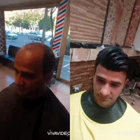پروتز مو پروتز جلو سر و شقیقه