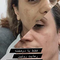 پاکسازی رایگان پوست مطهری|خدمات آرایشگری و زیبایی|رشت, خمیران زاهدان|دیوار