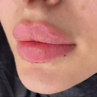 کلینیک لیزر/لیفت/تزریق ژل نورامیس،رئوفیل/بوتاکس|خدمات آرایشگری و زیبایی|تهران, صادقیه|دیوار