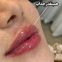جشنواره تزریق ژل و بوتاکس،فیلرلب،مزو،هایفو،آنزیم|خدمات آرایشگری و زیبایی|کرج, عظیمیه|دیوار