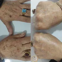 پلاسما جت. لیفت ولمینت ابرو و مژه|خدمات آرایشگری و زیبایی|اصفهان, خواجو|دیوار