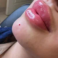 تخلیه چربی و تزریق به باسن|خدمات آرایشگری و زیبایی|تهران, شهرک ولیعصر جنوبی|دیوار