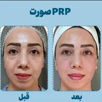 ۸۰درصد تخفیف در/لیزر/مزوتراپی/prp/جوانساز|خدمات آرایشگری و زیبایی|اندیشه, اندیشه فاز ۴|دیوار