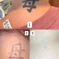 پاک کردن کامل تتو (ریموو با لیزر)