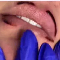 پاک کردن انواع تتو رنگی خالکوبی صورت وبدن بالیزر|خدمات آرایشگری و زیبایی|یاسوج, |دیوار