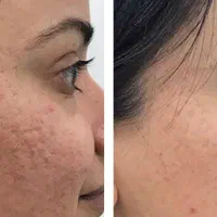 بوتاکس،مزوتراپی مو،ابرو،حذف خال زگیل،جای زخم وبخیه|خدمات آرایشگری و زیبایی|اسلام‌شهر, شهرک قائمیه|دیوار
