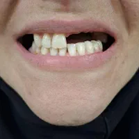 دندانپزشکی .دست دندان  هر فک ۴ میلیون تحویل ۳ روزه|خدمات آرایشگری و زیبایی|اسلام‌شهر, |دیوار