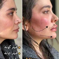 جشنواره بهاره ژل و بوتاکس آنزیم لیزر مزوتوسط پزشک|خدمات آرایشگری و زیبایی|کرج, جهان‌شهر|دیوار