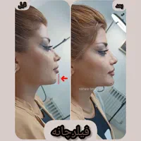 فیلرژل لب،ژل وبوتاکس تخصصی آقاوخانم در مطب پزشک|خدمات آرایشگری و زیبایی|شیراز, قصرالدشت|دیوار