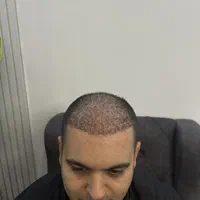 کاشت مو ابرو ریش کلینیک تخصصی اکسیر|خدمات آرایشگری و زیبایی|تبریز, |دیوار