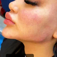 تزریق فیلر صورت مطابق المانهای زیبایی شناسی|خدمات آرایشگری و زیبایی|ورامین, |دیوار