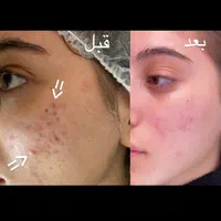 پاکسازی پوست فشیال لیزر پوست فیشیال|خدمات آرایشگری و زیبایی|شیراز, درکی|دیوار