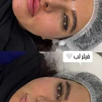 جشنواره تزریق ژل ، بوتاکس ،فیلر بادی ، نخ ،لیزر|خدمات آرایشگری و زیبایی|شیراز, فرهنگ شهر|دیوار