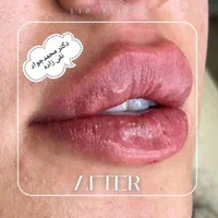 ژل فیلر لب صورت اندام بوتاکس مزوتراپی لیفت رژیم