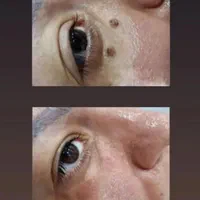 برداشت خال با خلال دندان