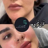 بوتاکس ژل لب زاویه فک.گونه .چانه. پرکردن صورت لاغر|خدمات آرایشگری و زیبایی|قم, زنبیل آباد|دیوار