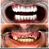 روکش دندان زیرکونیا مناسب|خدمات آرایشگری و زیبایی|تهران, افسریه|دیوار