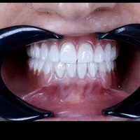 دست دندان طرح لمینیت|خدمات آرایشگری و زیبایی|تهران, مهران (سیدخندان)|دیوار
