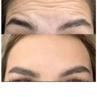 تزریق ژل بوتاکس لیزرمو مزو فیلرلب روسی لیفت صورت|خدمات آرایشگری و زیبایی|تهران, پونک|دیوار