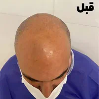 کاشت موی طبیعی|خدمات آرایشگری و زیبایی|اهواز, زیتون کارمندی|دیوار